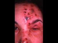 herpes zoster ophthalmicus