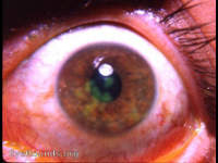 stained cornea - herpes simplex I of the cornea