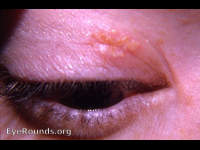 herpes simplex I of the lid