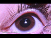 Heterochromia with Horner's syndrome. Normal OS is brown