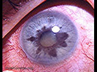 heterochromia iridis caused by chronic cyclitis