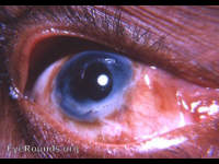 heterochromia