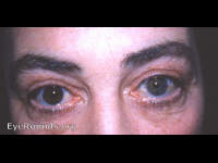 Heterochromia