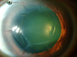 Hexagonal keratotomy