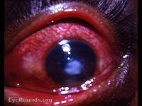 Hypopyon ulcer