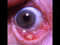 internal hordeolum - a meibomian abscess