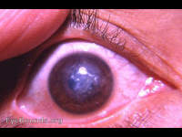 herpes simplex virus disciform keratitis - calcified