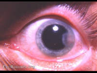 disciform keratitis