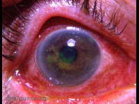 dendritic keratitis - stained