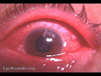 dendritic keratitis HSV