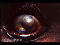 Ciliary staphyloma with descemetocele