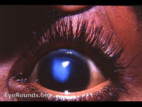 leucoma with striae/folds (Haab's Striae) in Descemet's membrane