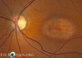 Bull's-eye maculopathy due to hydroxychloroquine toxicity