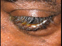 hypertrichiasis