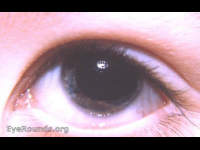 hypoplasia of the iris