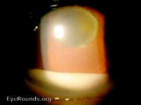 Hypopyon