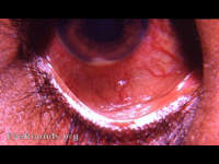endogenous suppurative iritis