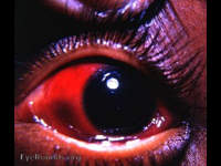 Bulbar subconjunctival hemorrhage