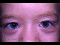 ichthyosis