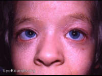 congenital ichthyosis with bilateral ectropion