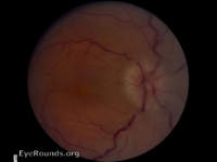 Neuroretinitis