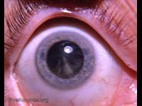 immature cuneiform senile cortical cataract