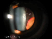 intraocular gancyclovir implant
