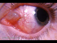 Epithelial inclusion cyst, conjunctiva