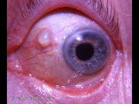 conjunctival implantation cyst