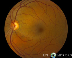Optic Disc Notch and Retinal Nerve Fiber Layer Defect in Primary Open Angle Glaucoma
