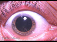incipient, immature cortical cataractous changes in the inferior-nasal quadrant of the lens