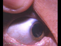 incipient cortical cataractous changes