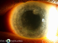 Interstitial keratitis