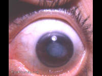Interstitial keratitis due to congenital syphilis