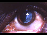 intracapsular cataract extraction that failed-ending up as an extracapsular extraction with retention of significant lens material