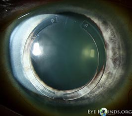 Intrastromal corneal ring segments (aka intracorneal rings, Intacs)