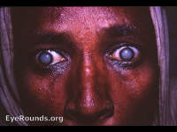 bilateral intumescent cataract