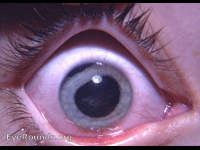 traumatic iridodialysis with slight anterior cortical traumatic cataract