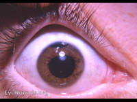 traumatic iridodialysis with concussion cataract