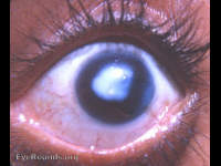 Corneal leukoma with iridodialysis