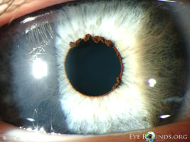 Iris flocculus