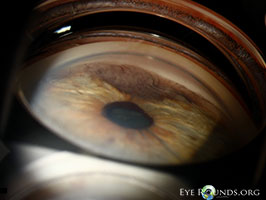Iris Melanoma
