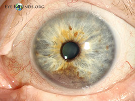 Iris melanoma