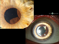 Iris pigment epithelial cysts