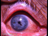 freckled iris with iris nevus