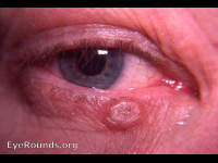 Irritated keratotic lesion (irritated skin lesion of right lower lid)