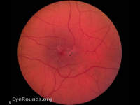 juxtafoveal telangiectasia