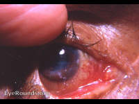 Keratitis e lagophthalmos with lateral tarsorraphy