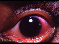 keratitis- an autoimmune response