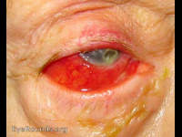 pseudomonas keratitis (suppurative)